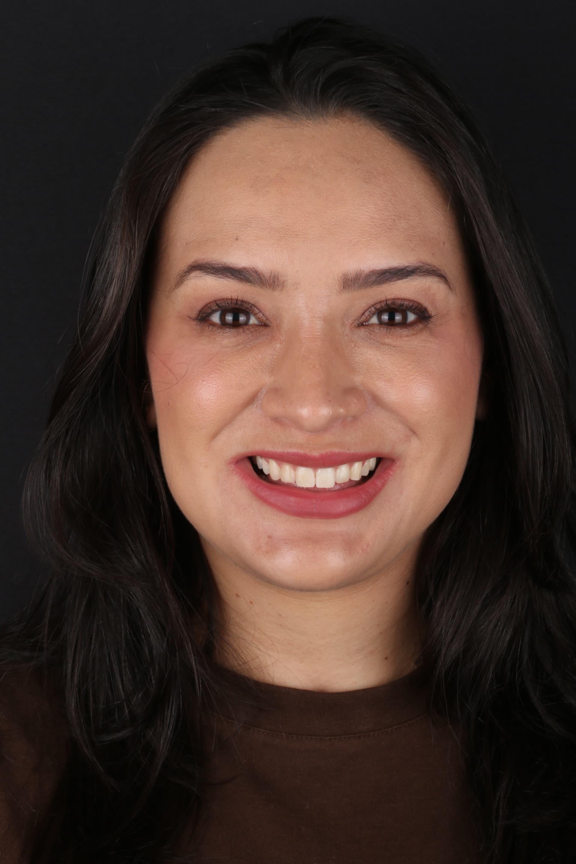 Sorriso antes do procedimento de lentes