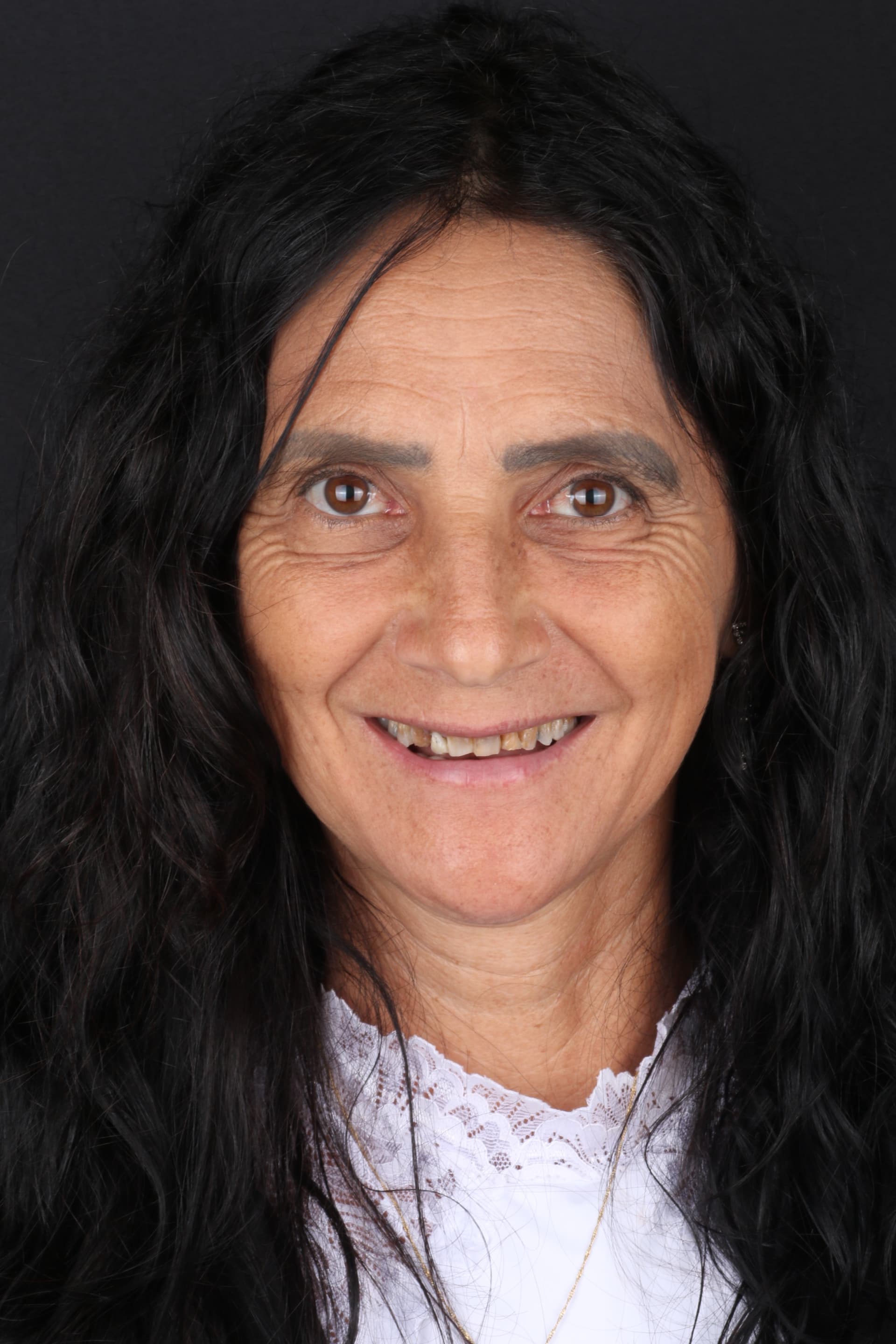 Sorriso antes do procedimento de lentes