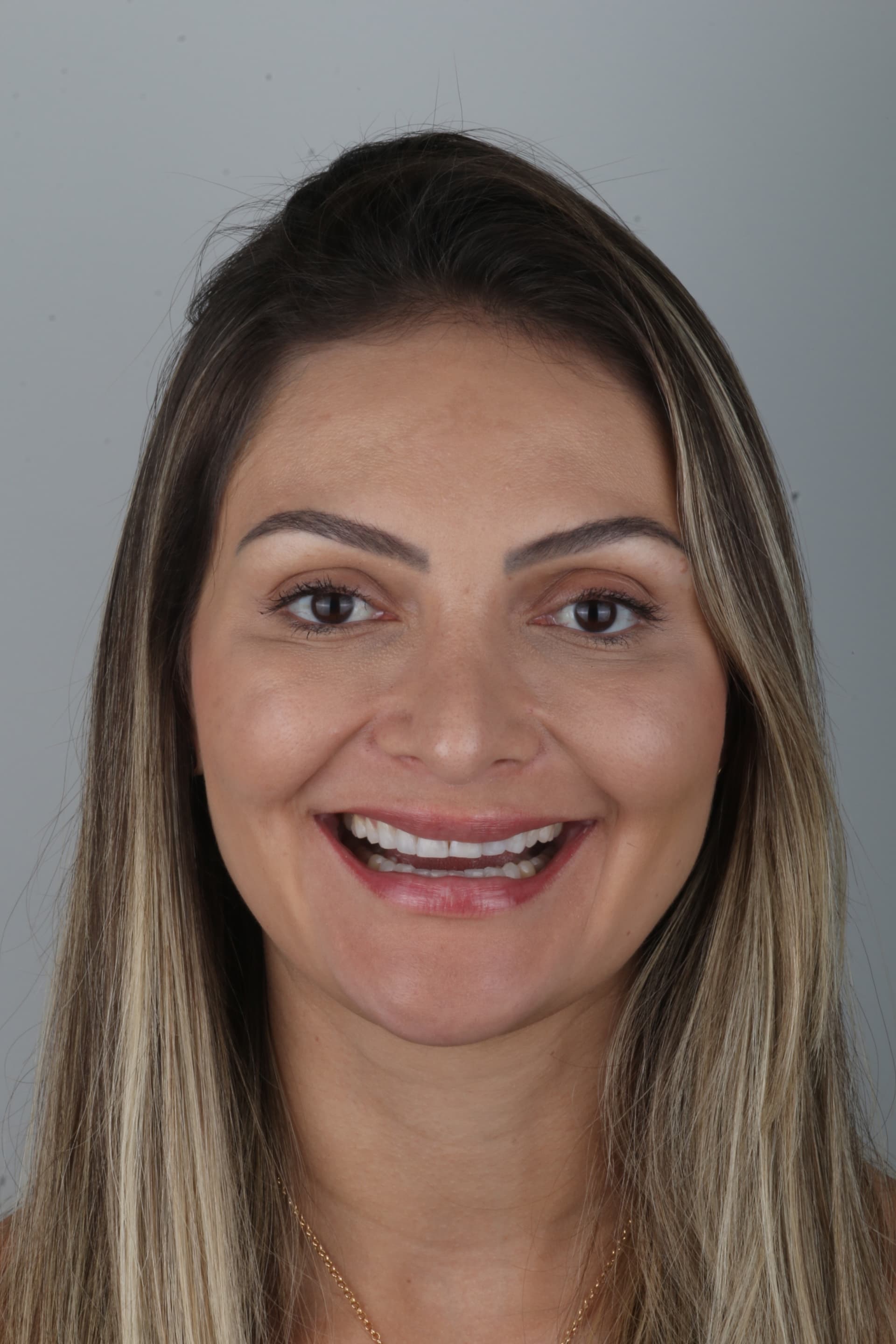 Sorriso antes do procedimento de lentes