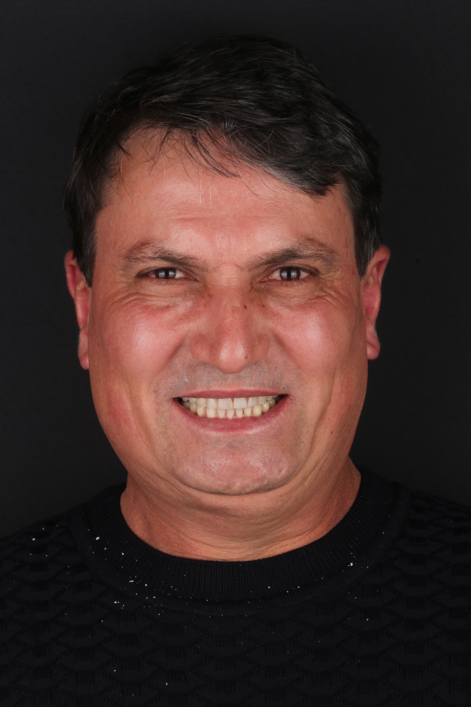 Sorriso antes do procedimento de lentes