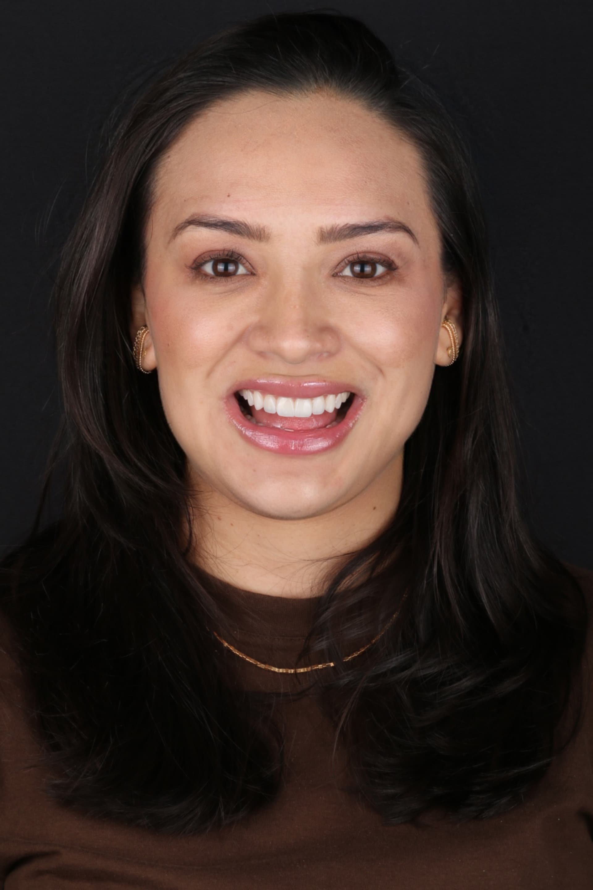 Sorriso após lentes, resultado natural