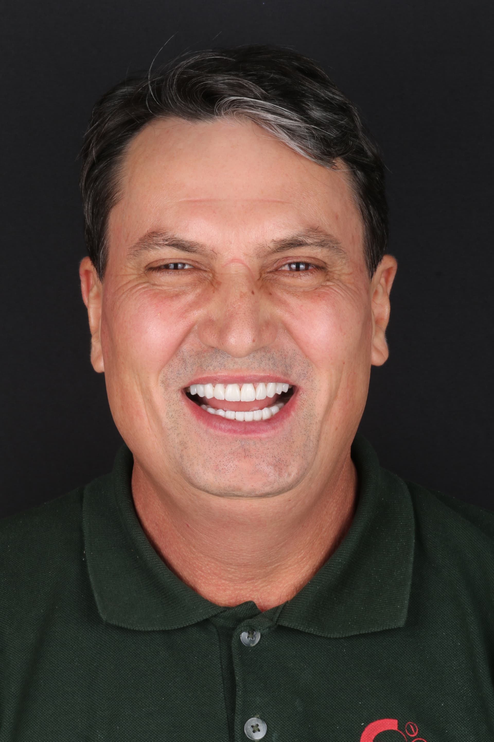 Sorriso após lentes, resultado natural