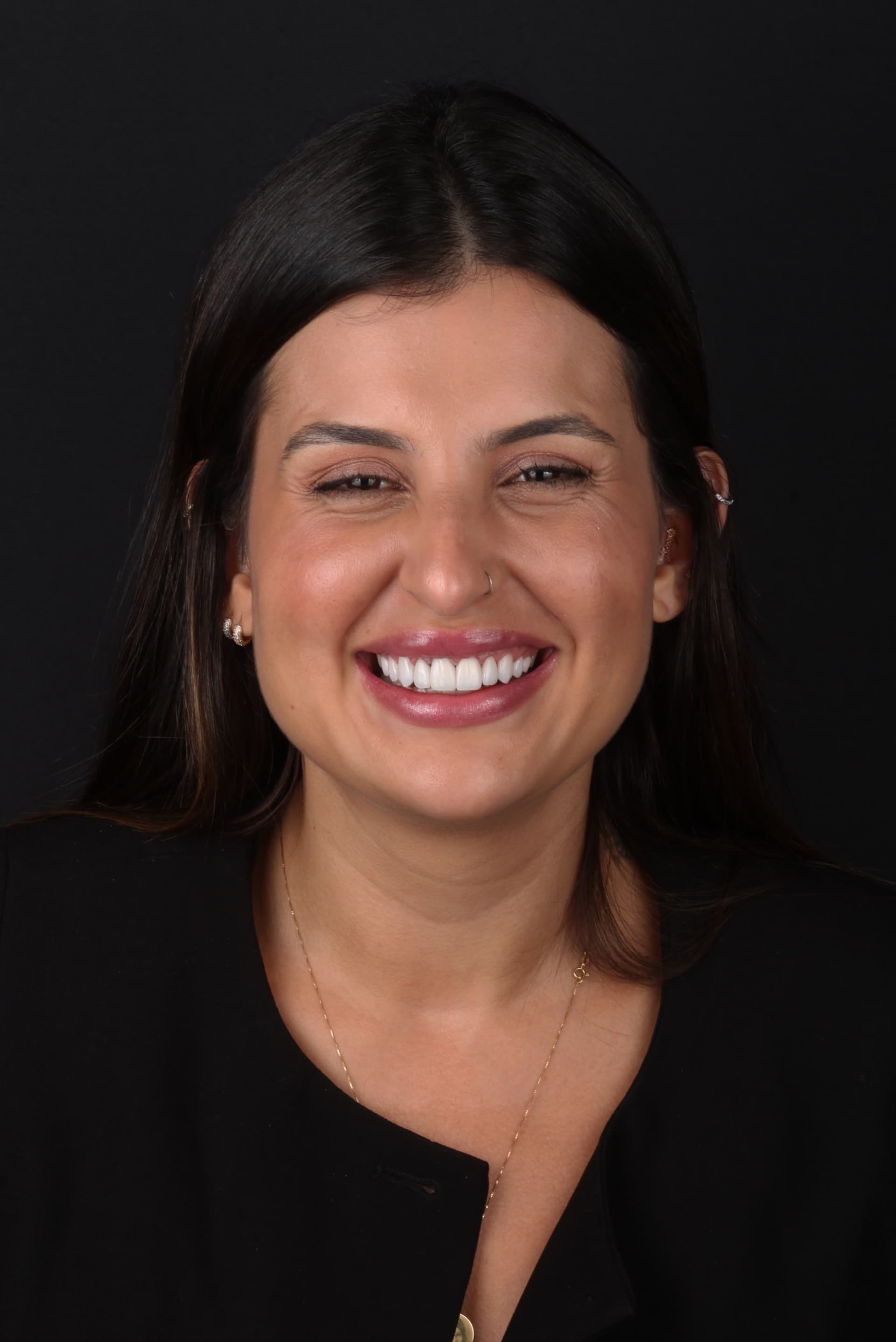 Sorriso após lentes, resultado natural