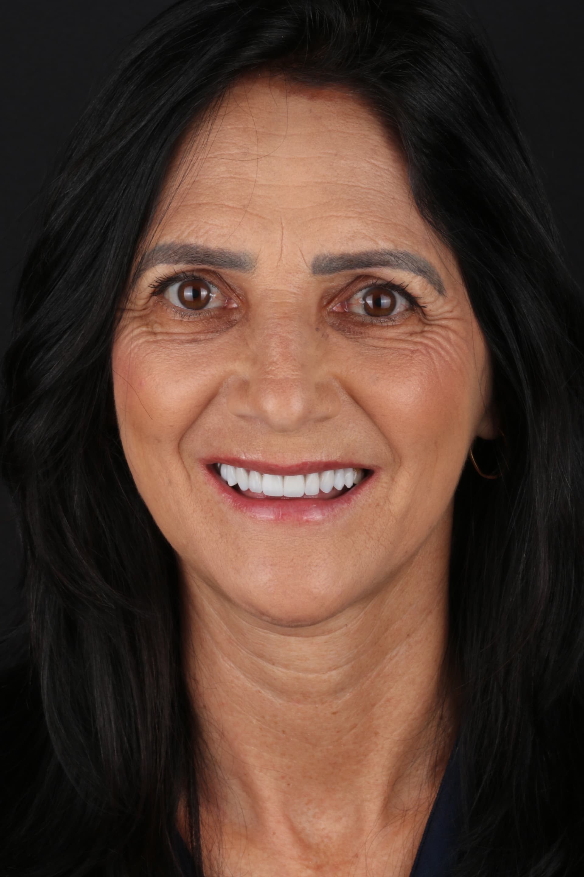 Sorriso após lentes, resultado natural